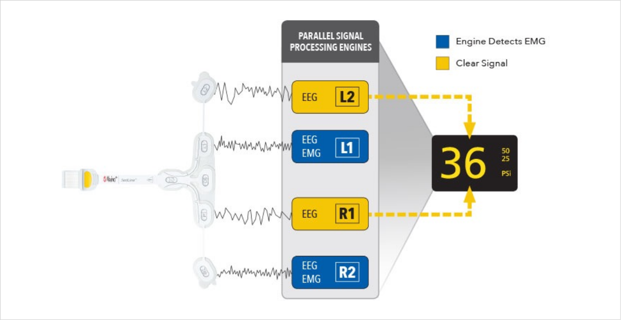 EMG Graph