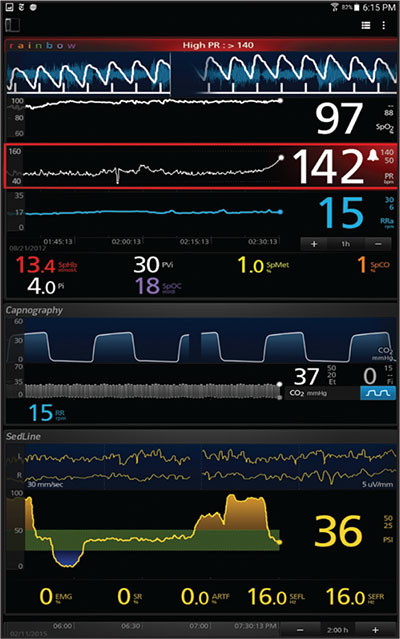 Masimo Kite displaying visual alarms